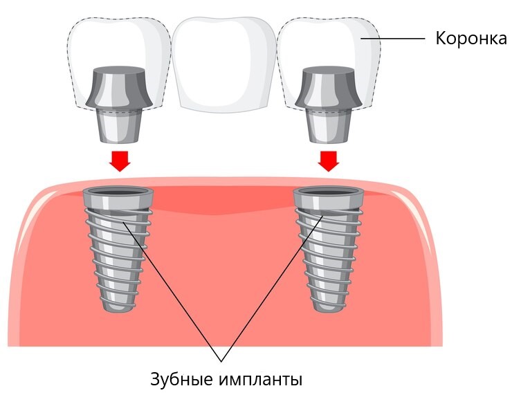 Импланты за один день