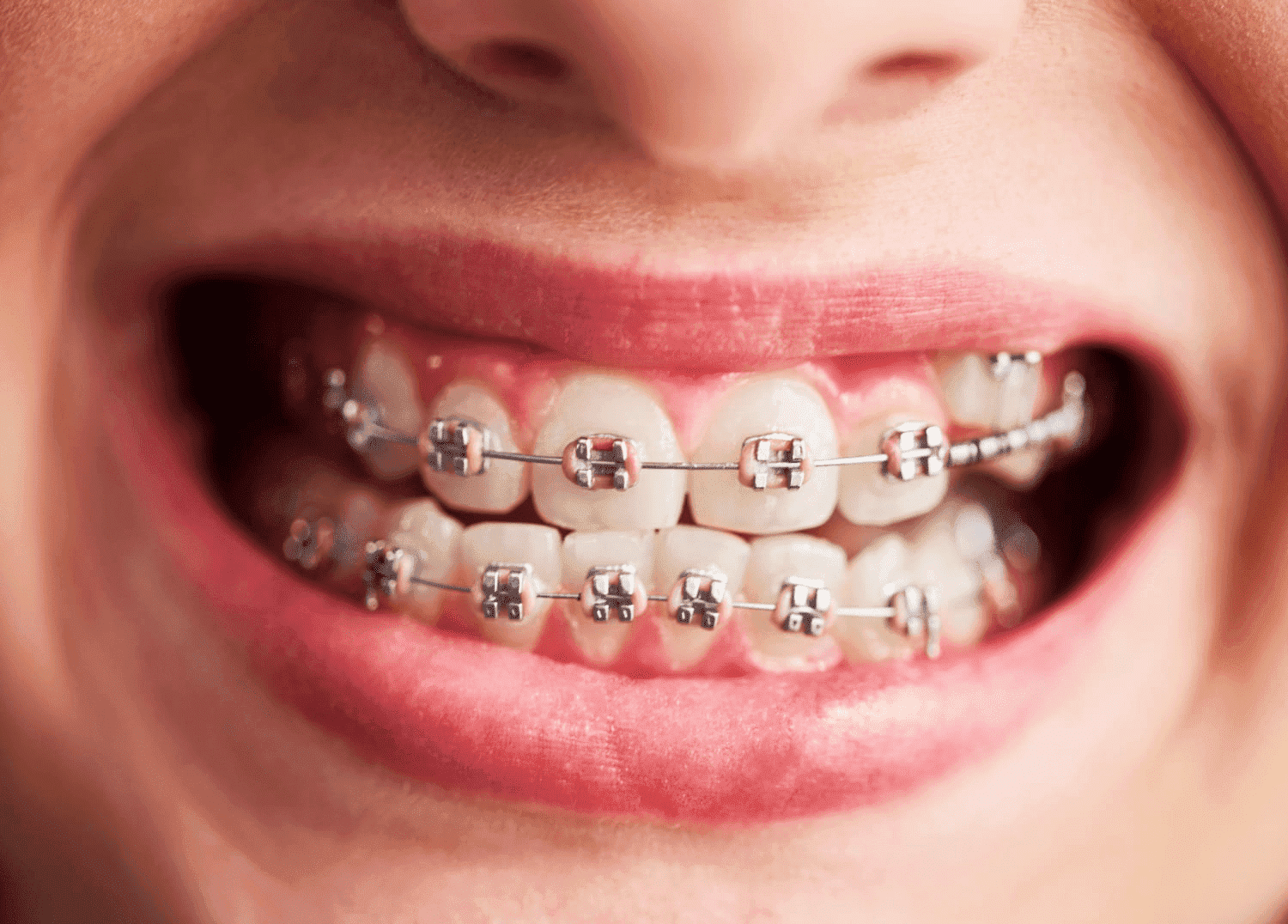 Ортодонтические скобы для выравнивания зубов