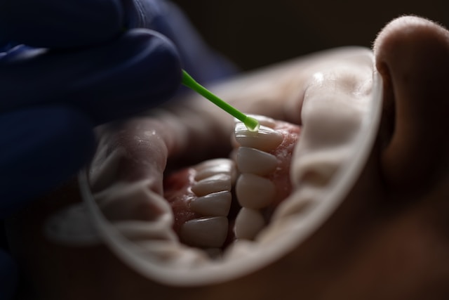 Покрытие зубов фторлаком Томск Олимпийская стоматология уринг томск