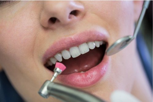 Покрытие зубов фторлаком Томск Сосновая томск семейная стоматология