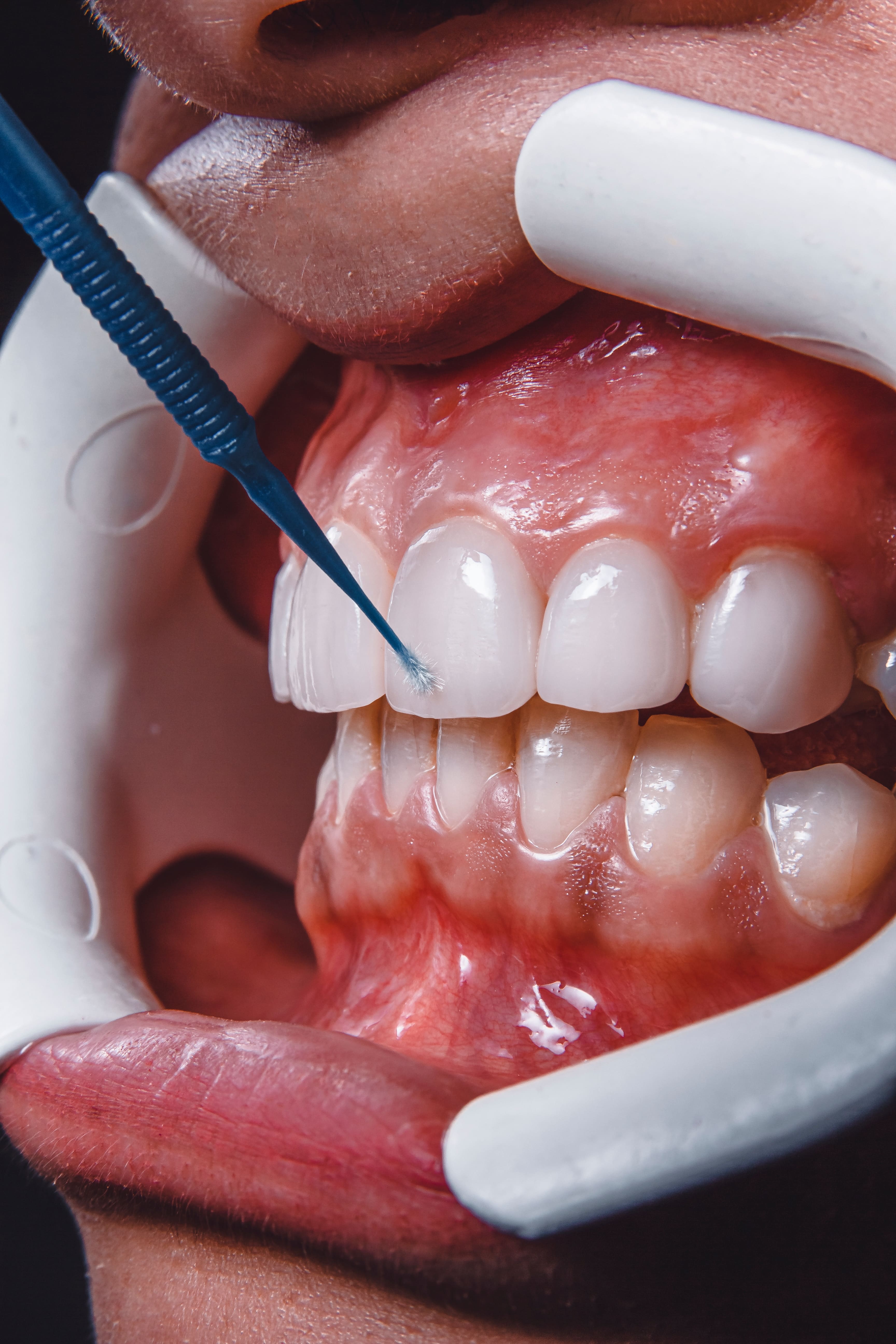 Покрытие зуба защитным лаком Томск Сплавная тверстом стоматология томск официальный