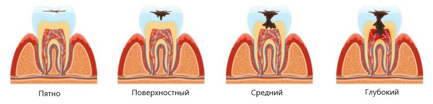 Лечение среднего кариеса